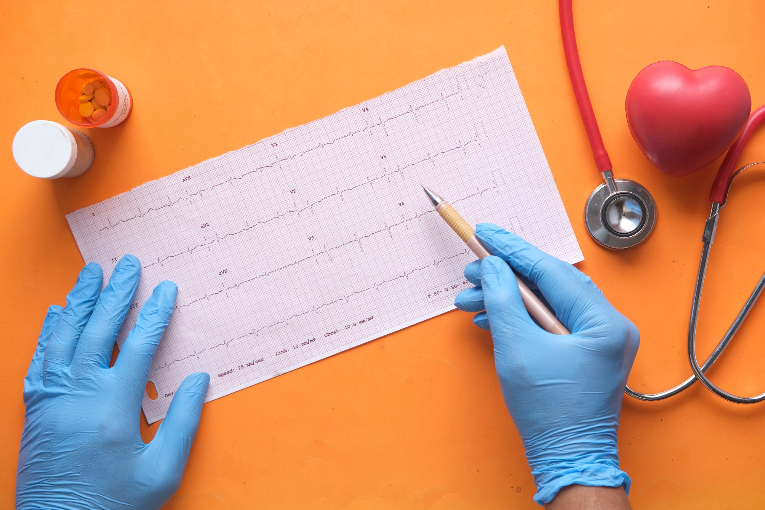 Telecordis: image of ecg